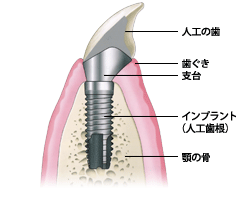 インプラント治療について　イメージ