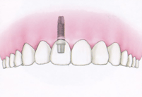 インプラント　イメージ