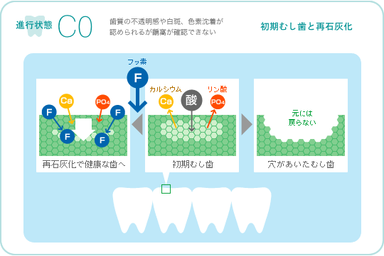 初期むし歯と再石灰化　イメージ